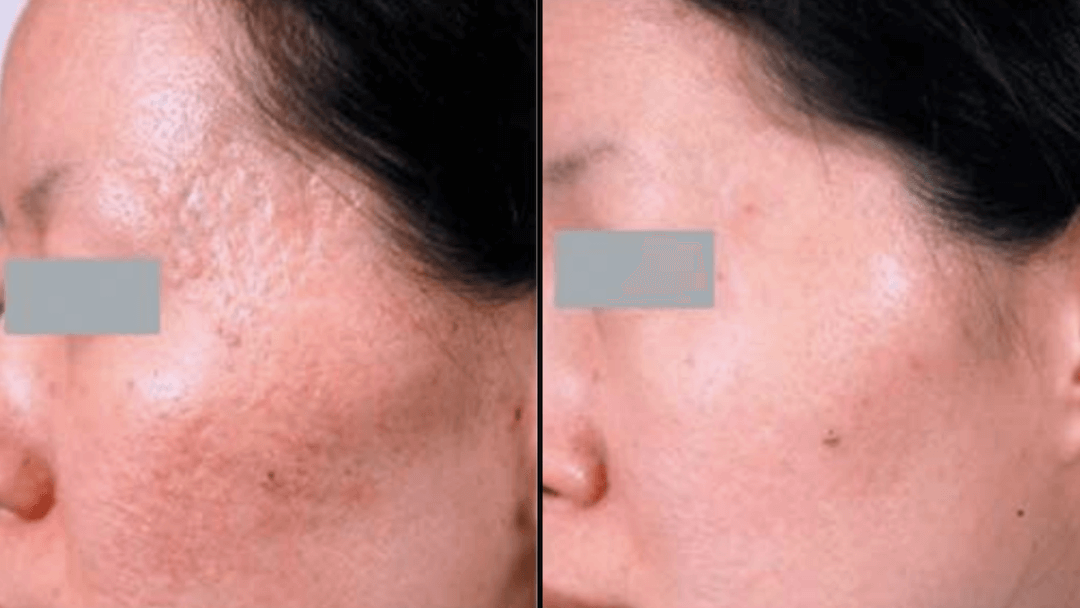 botox-no-rosto-bh