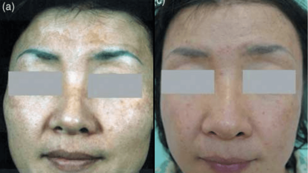botox-no-rosto-bh