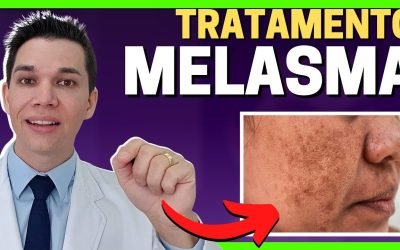 Melasma: o que é, por que aparece e como tratar