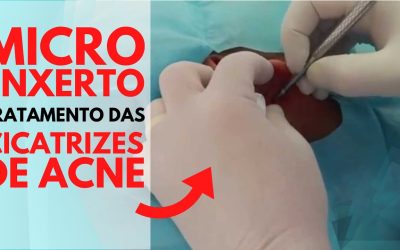 Tipos de cicatriz de acne e o tratamento indicado para cada uma
